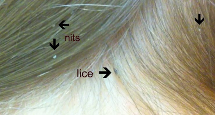 How to Tell Lice