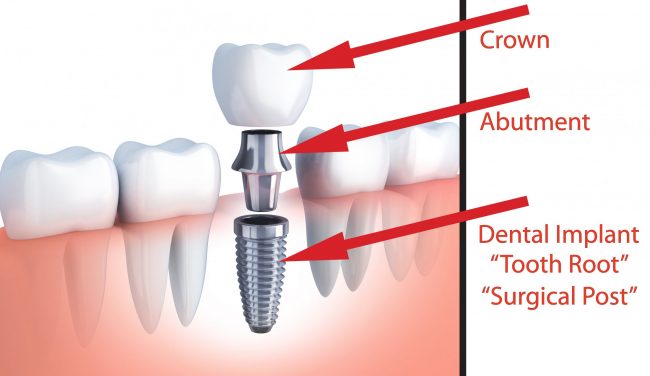 Signs of a Failed Dental Implant