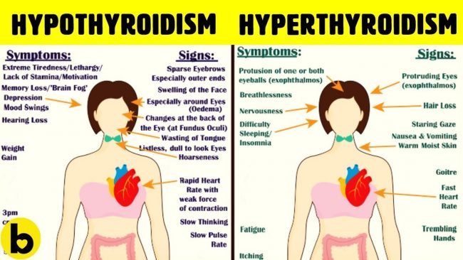 Hypothyroidism: The Great Imposter