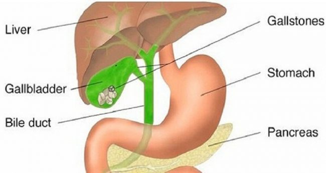 Can You Get Rid Of Gallbladder Stone Without Operation?