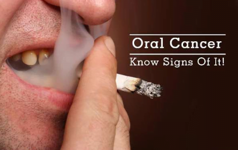 Warning Signs of Oral Cancer