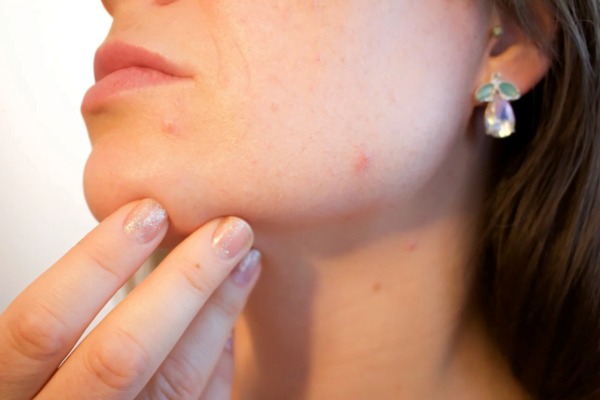 Clear Your Skin and Fight Off Acne in 4 Steps
