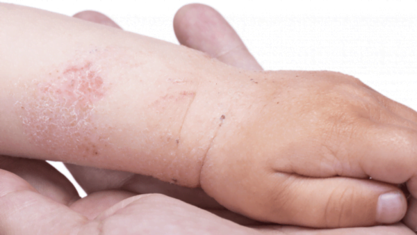 Five Latest Complementary and Alternative Treatments for Eczema