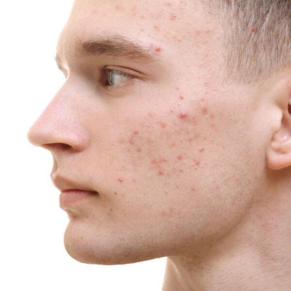 Do You Know What Type of Acne You Have?