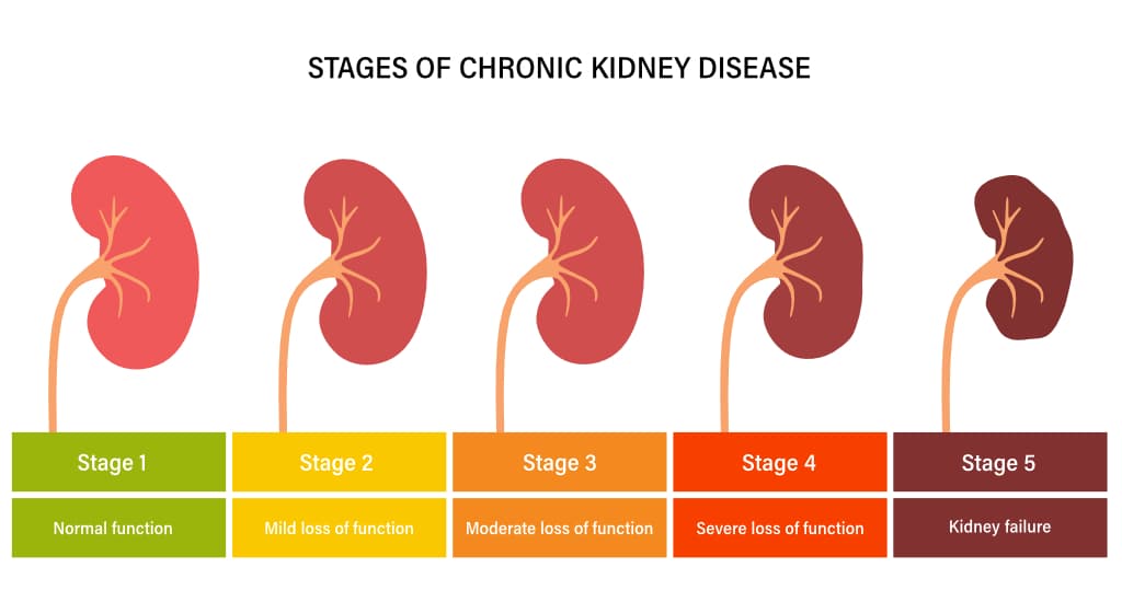 5 Causes and Risk Factors for Chronic Kidney Disease