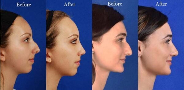 Rhinoplasty: More Than Just a Cosmetic Procedure