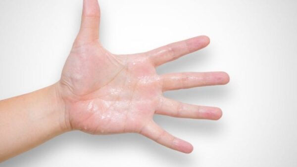 How To Reduce The Effects of Hyperhidrosis