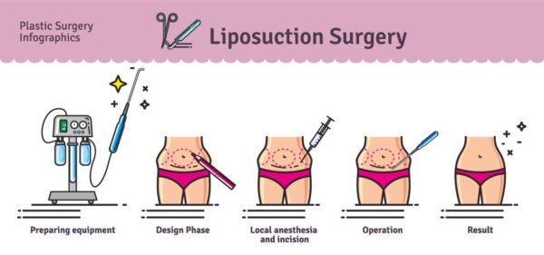Liposuction Appointment Coming Up? Here’s How to Prepare for It & What to Expect